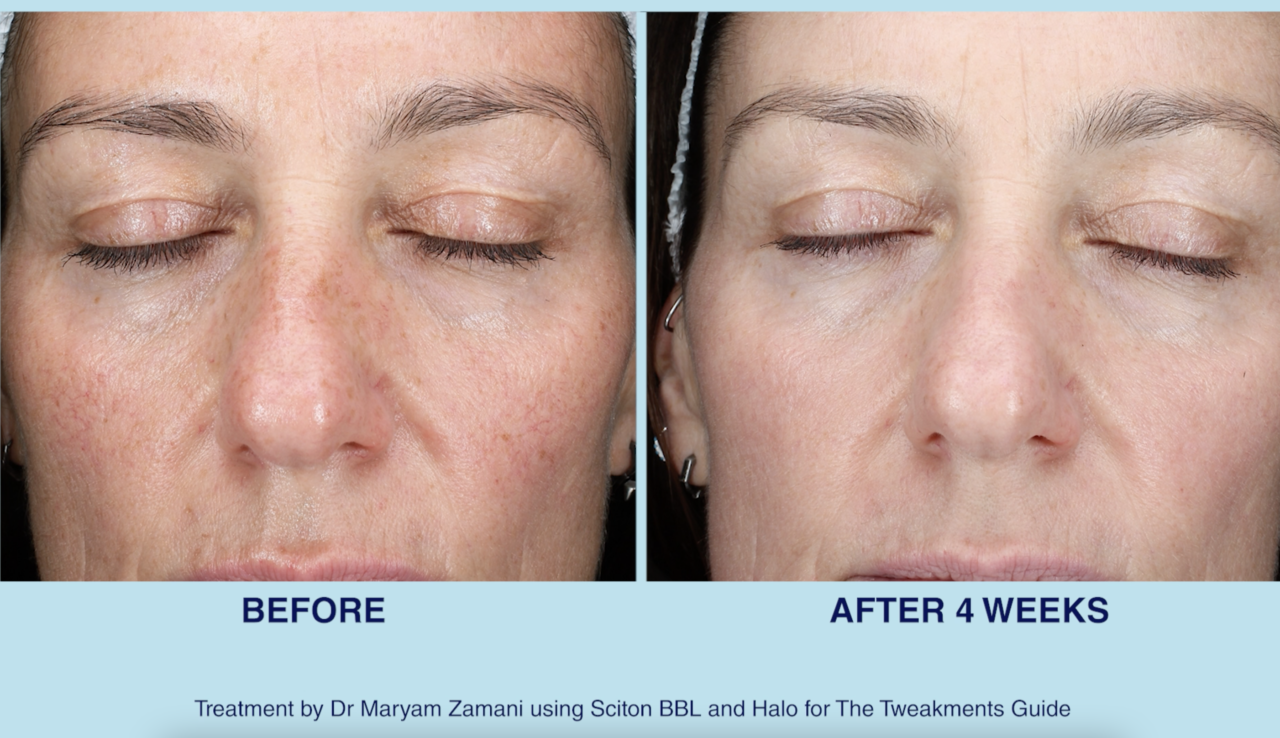 BBL with Dr Maryam Zamani before and after