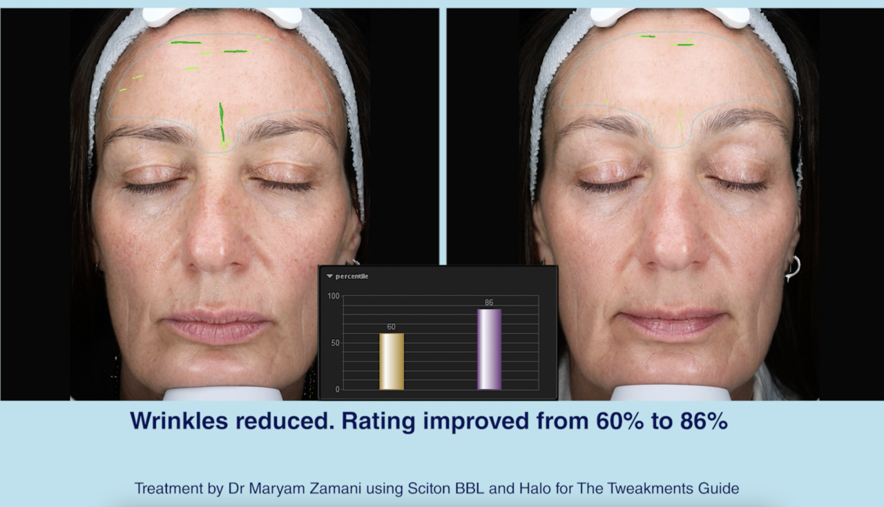 Sciton Lasers Before and After with Dr Maryam Zamani