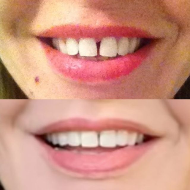 Alice Hart-Davis's teeth before and after Invisalign treatment 